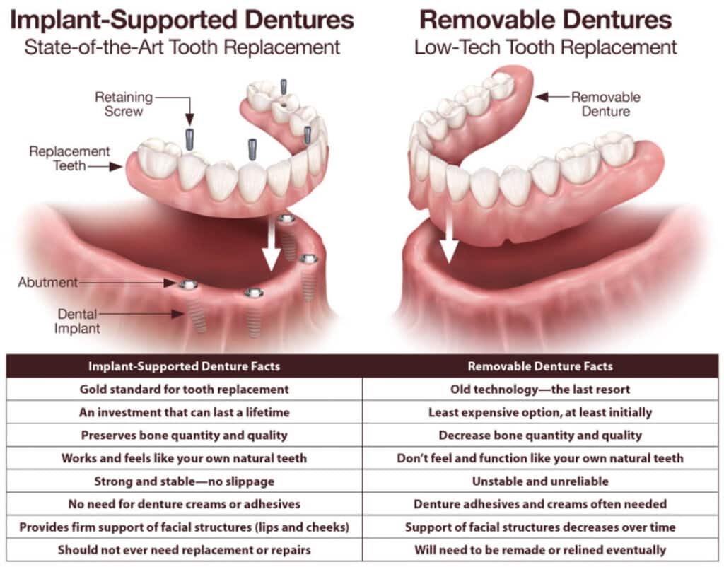 Implant-supported dentures