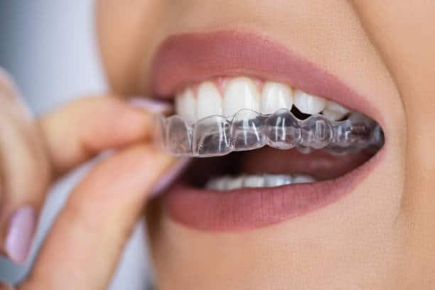 Invisalign retainers