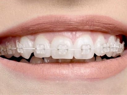 Clear ceramic braces