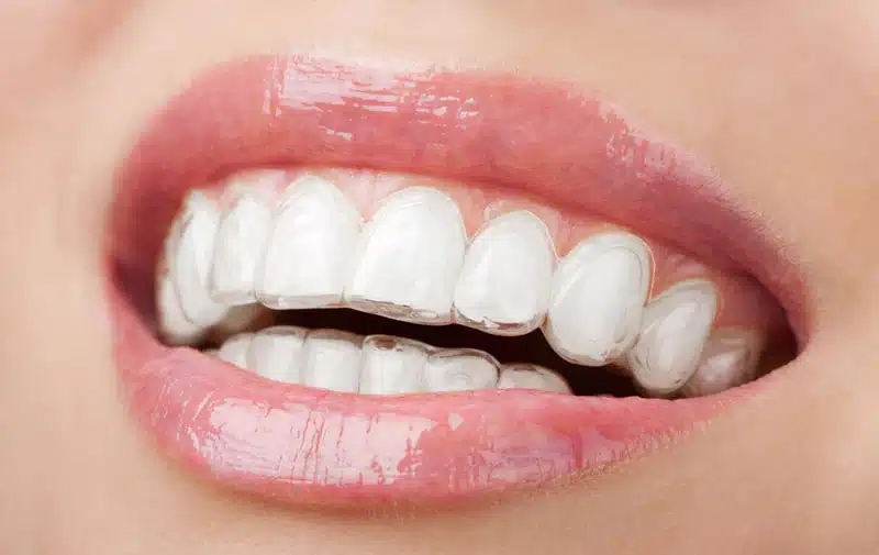 Invisible aligners