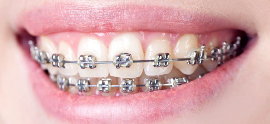 Traditional metal braces