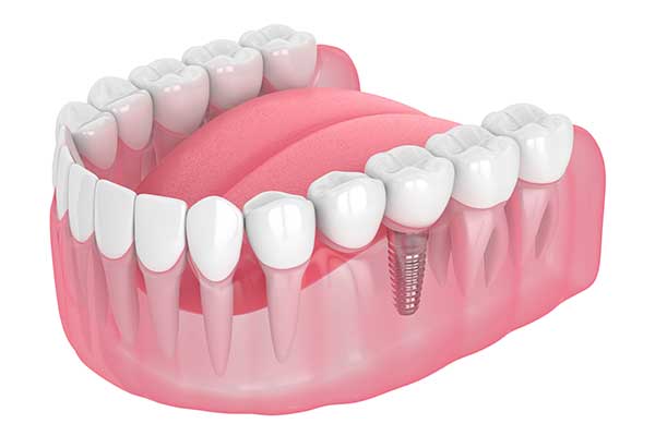 metal dental implant